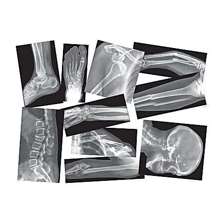 Roylco Broken Bones X-rays Set - Theme/Subject: Radiology - Skill Learning: Anatomy - 15 Pieces - 4+ - 15 / Box